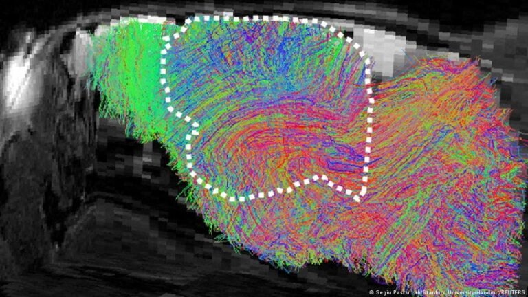 Investigadores logran avances al trasplantar tejido cerebral humano cultivado en laboratorio a roedores